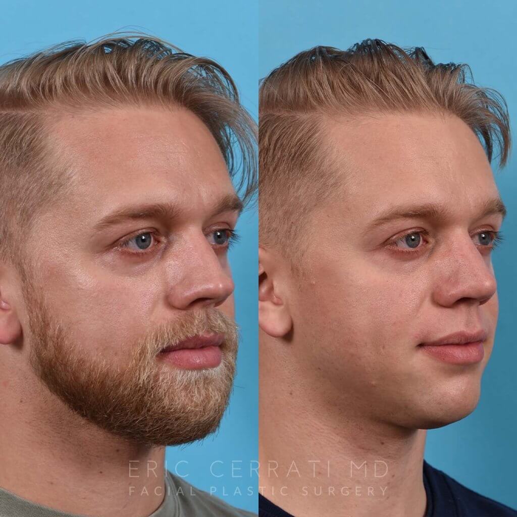 Male patient before and after rhinoplasty - right side