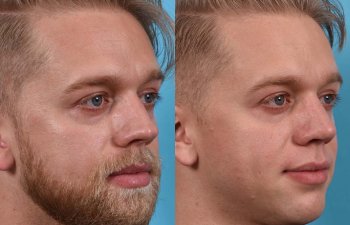 Male patient before and after rhinoplasty - right side