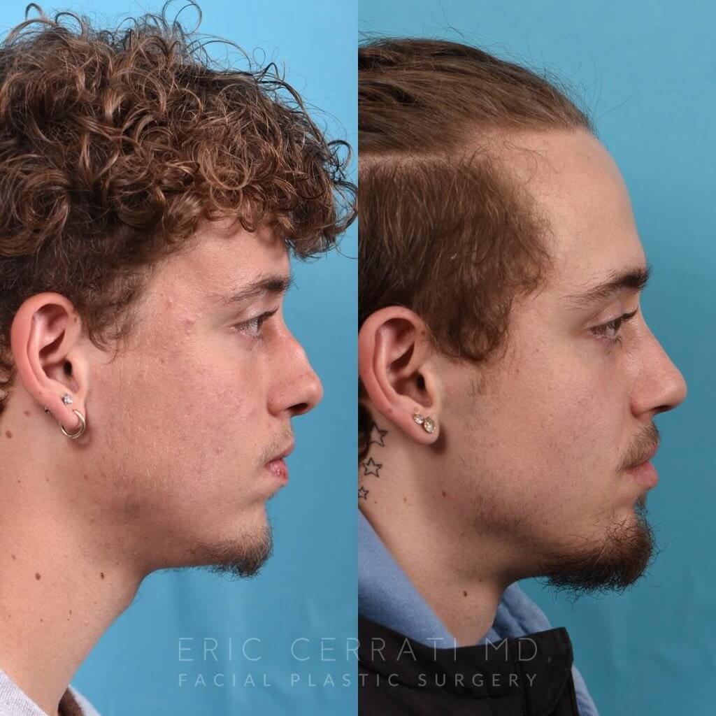 Male patient before and after rhinoplasty - right side