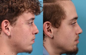 Male patient before and after rhinoplasty - right side