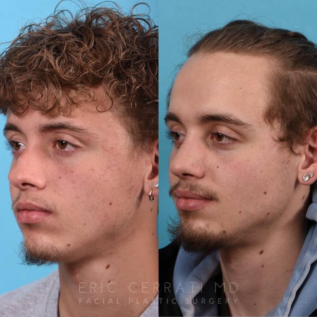Male patient before and after rhinoplasty - left side
