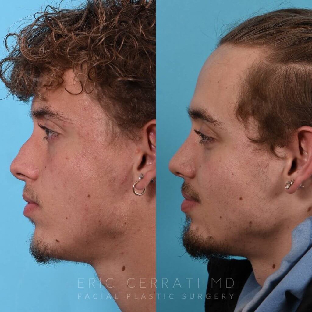 Male patient before and after rhinoplasty - left side
