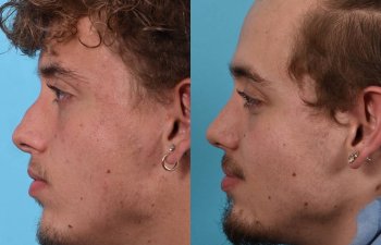 Male patient before and after rhinoplasty - left side