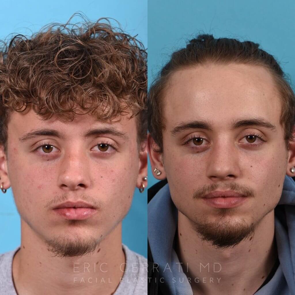 Male patient before and after rhinoplasty - front