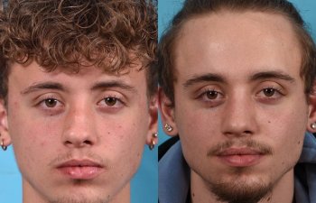 Male patient before and after rhinoplasty - front