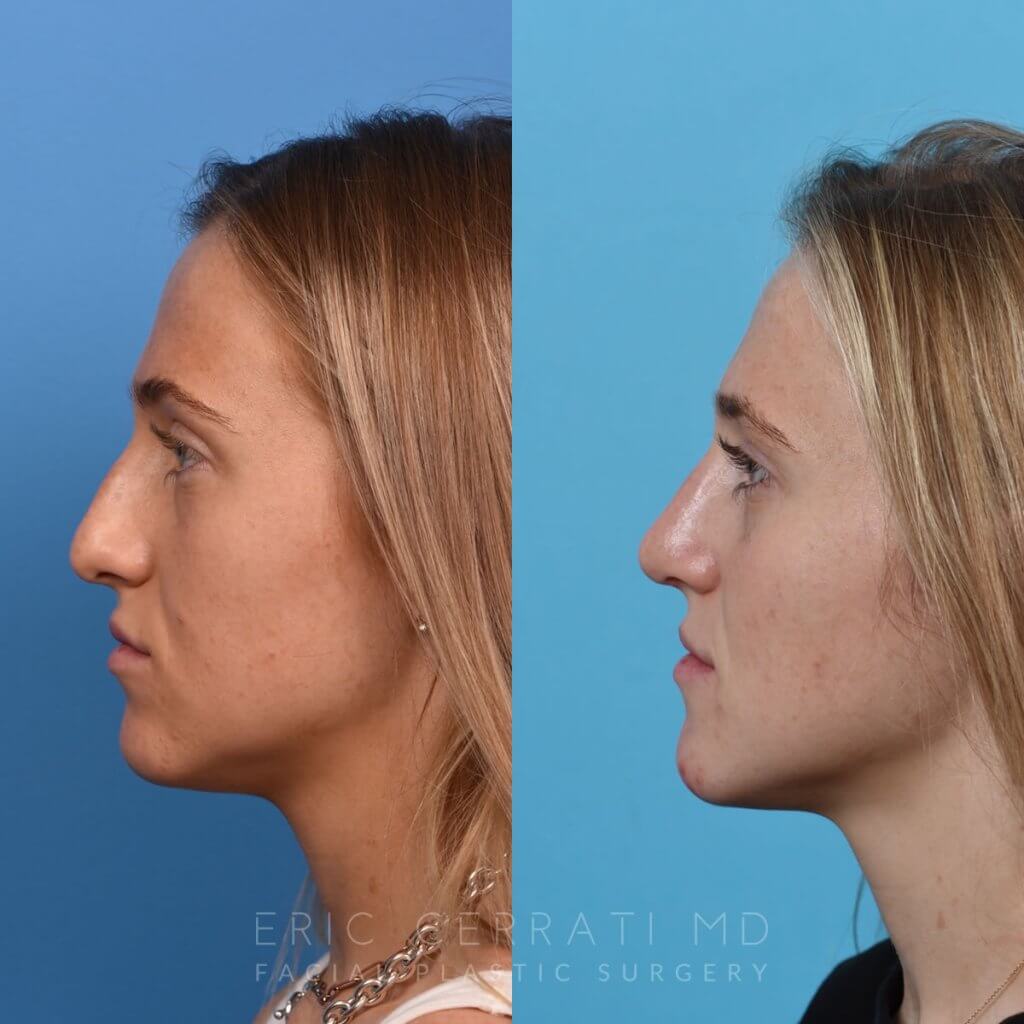 Female patient before and after rhinoplasty - left side
