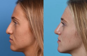 Female patient before and after rhinoplasty - left side