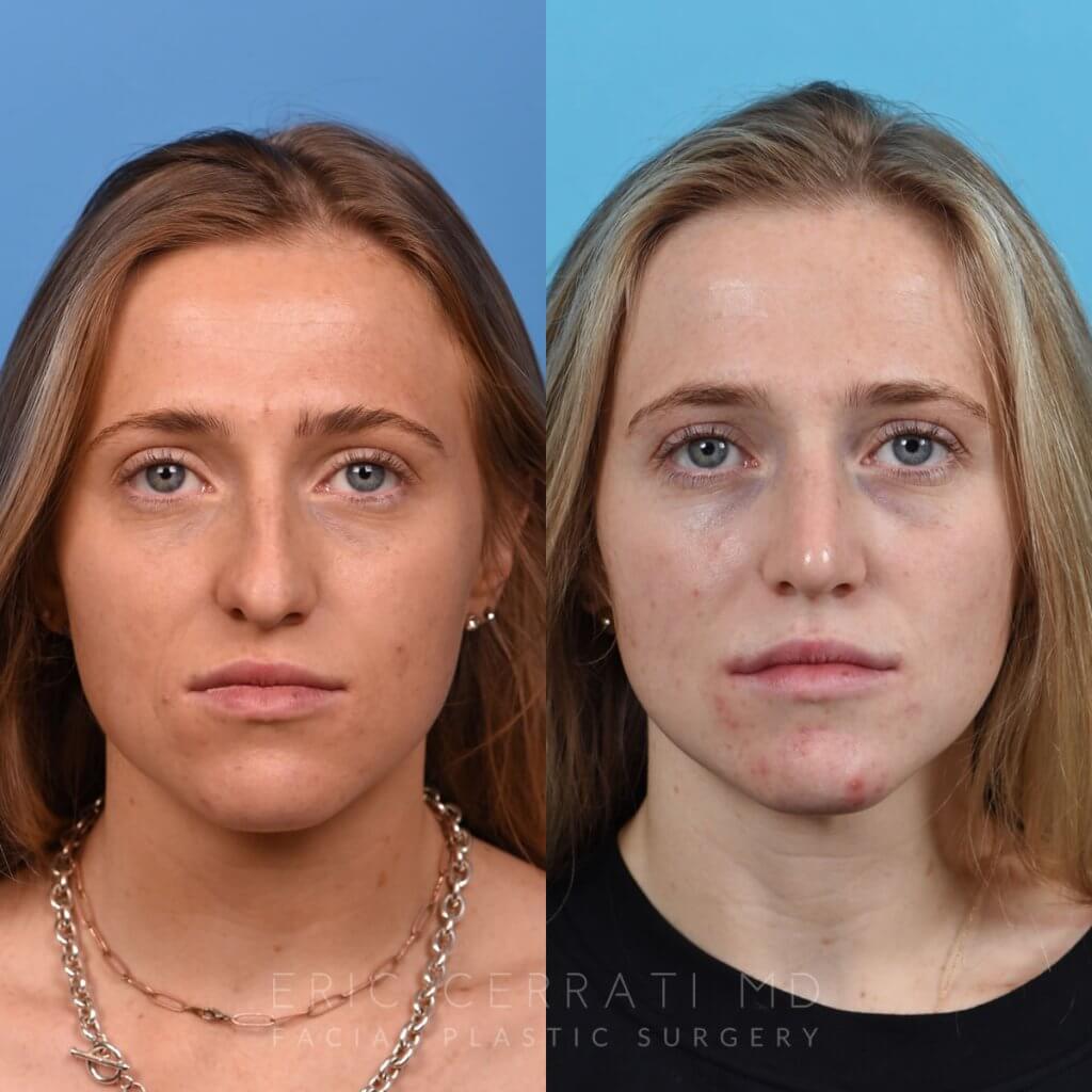 Female patient before and after rhinoplasty - front