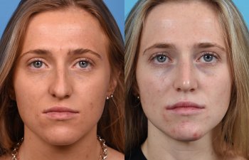 Female patient before and after rhinoplasty - front