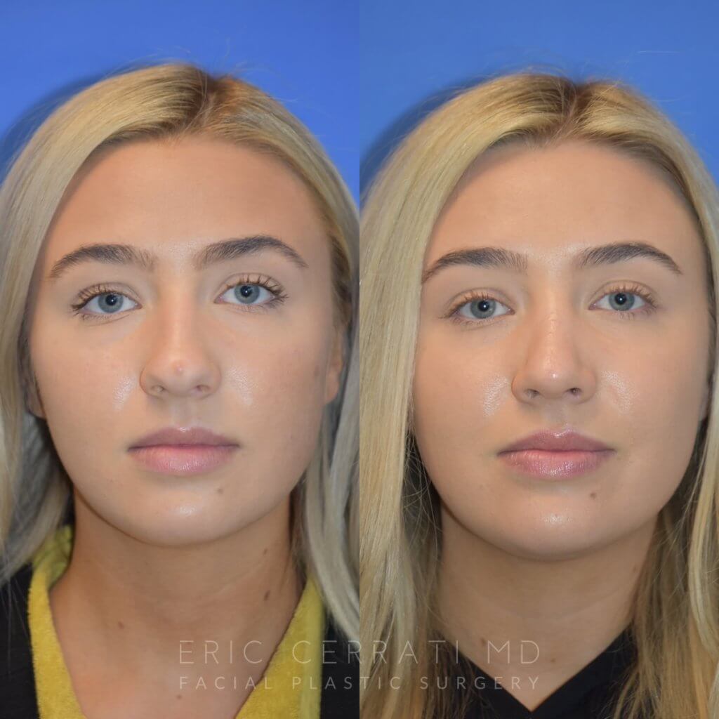 Female patient before and after rhinoplasty - front