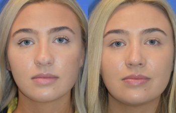 Female patient before and after rhinoplasty - front