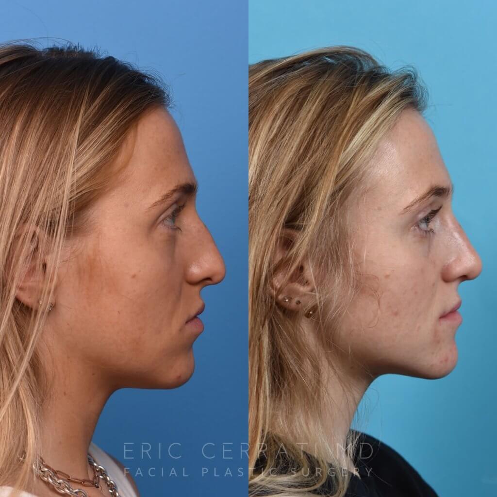 Female patient before and after rhinoplasty - right side