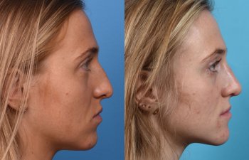 Female patient before and after rhinoplasty - right side