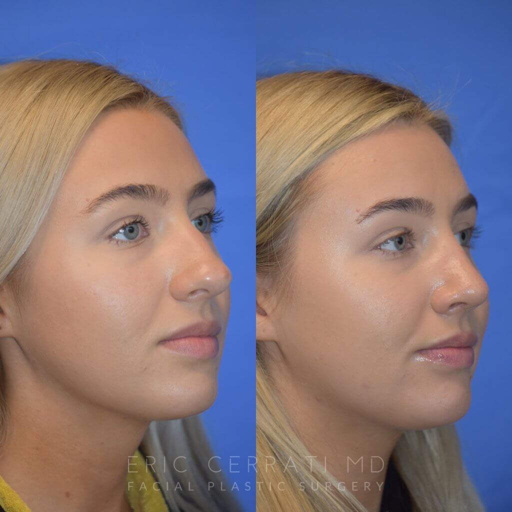 Female patient before and after rhinoplasty - right side