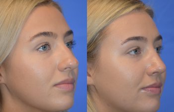 Female patient before and after rhinoplasty - right side