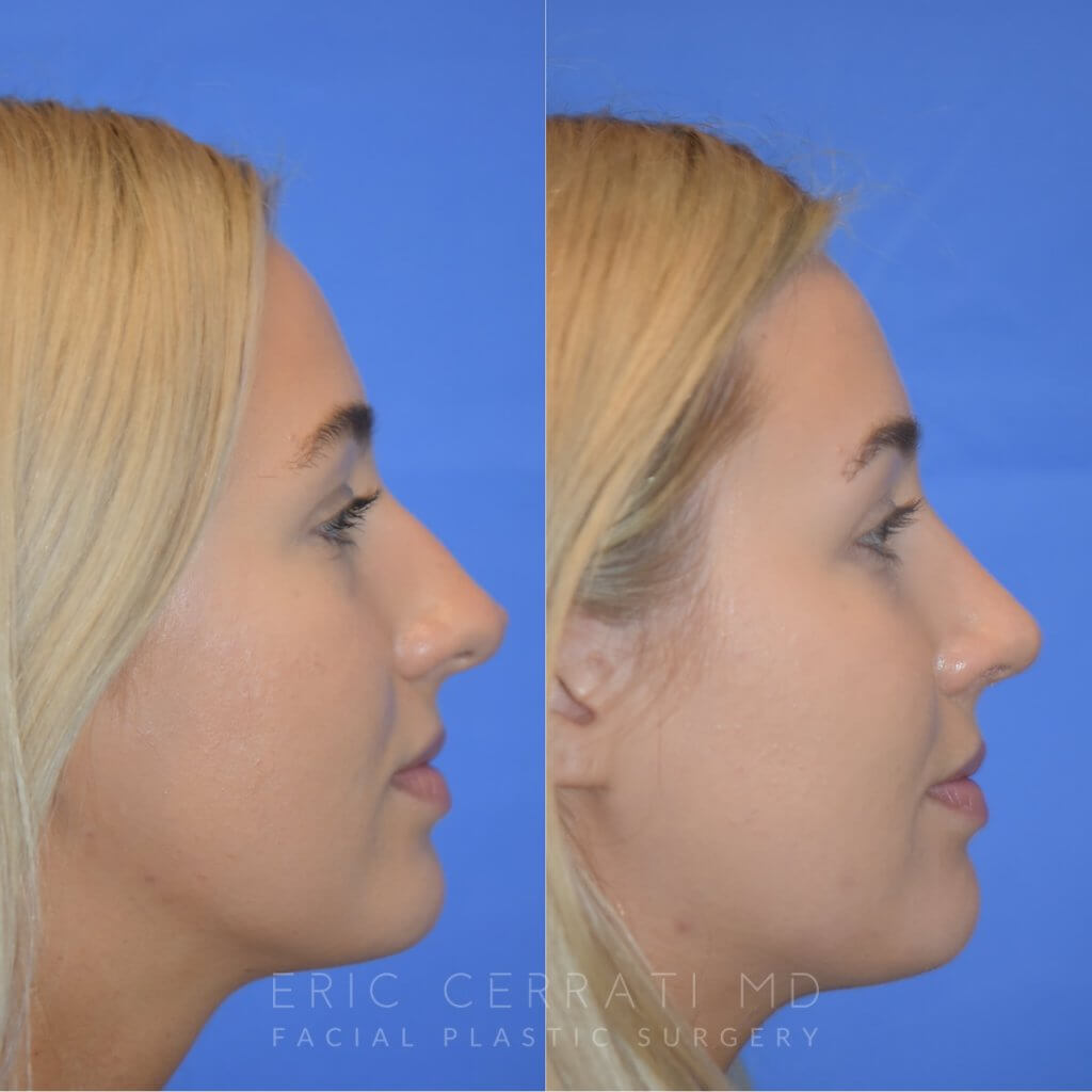 Female patient before and after rhinoplasty - right side