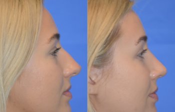 Female patient before and after rhinoplasty - right side