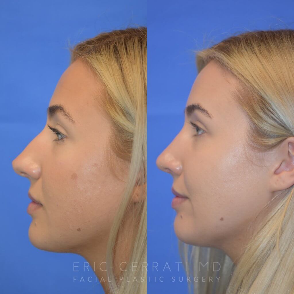 Female patient before and after rhinoplasty - left side