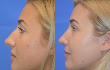 Female patient before and after rhinoplasty - left side