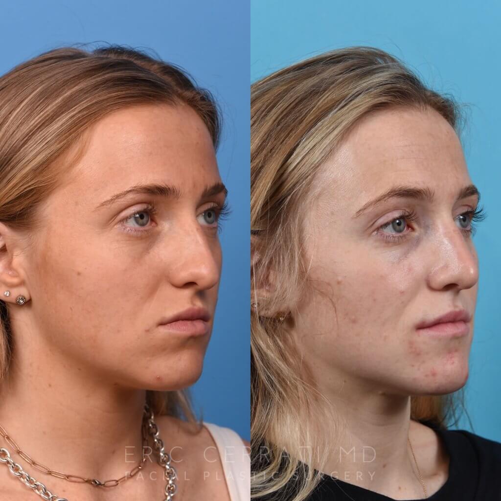 Female patient before and after rhinoplasty - right side