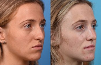 Female patient before and after rhinoplasty - right side