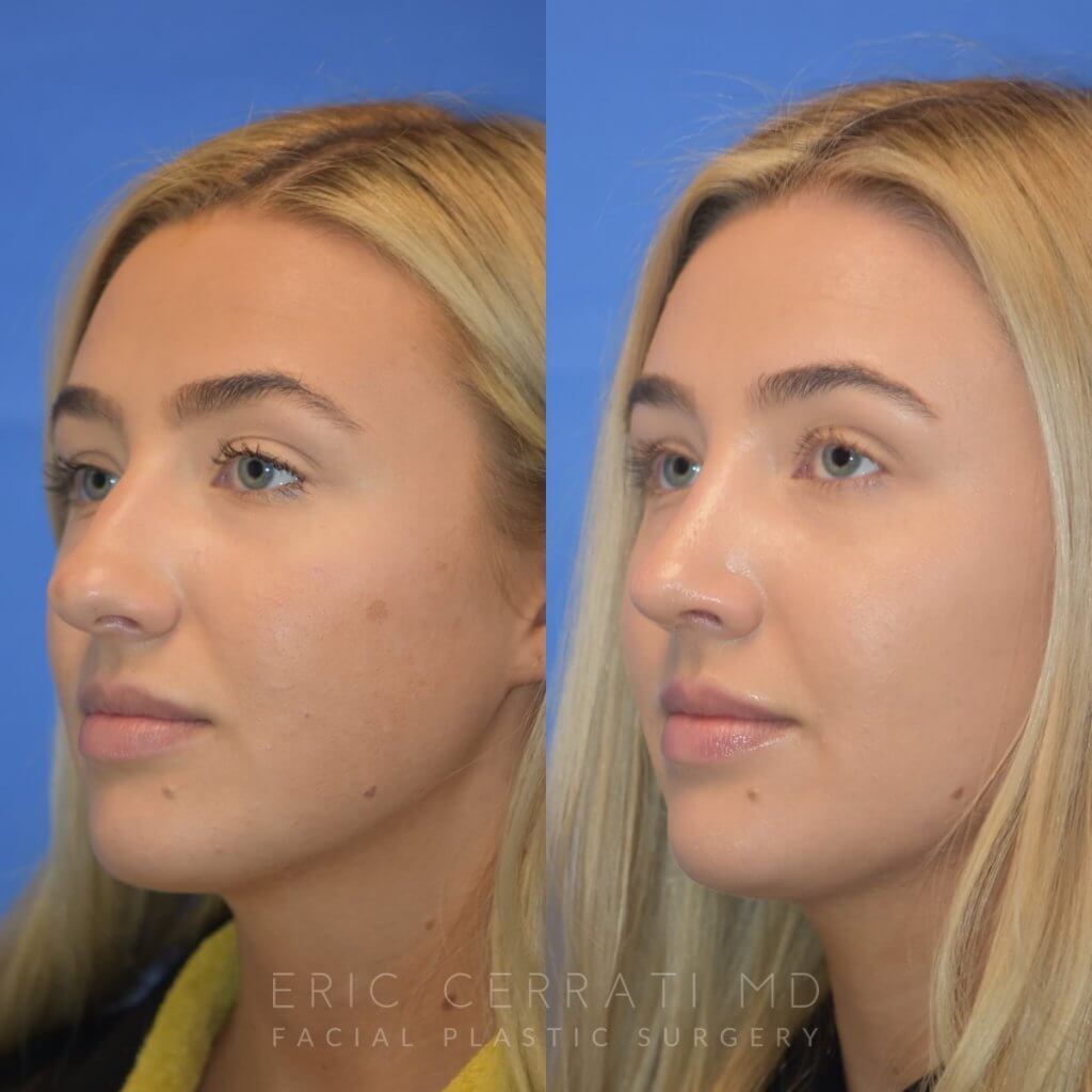 Female patient before and after rhinoplasty - left side