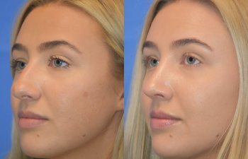 Female patient before and after rhinoplasty - left side