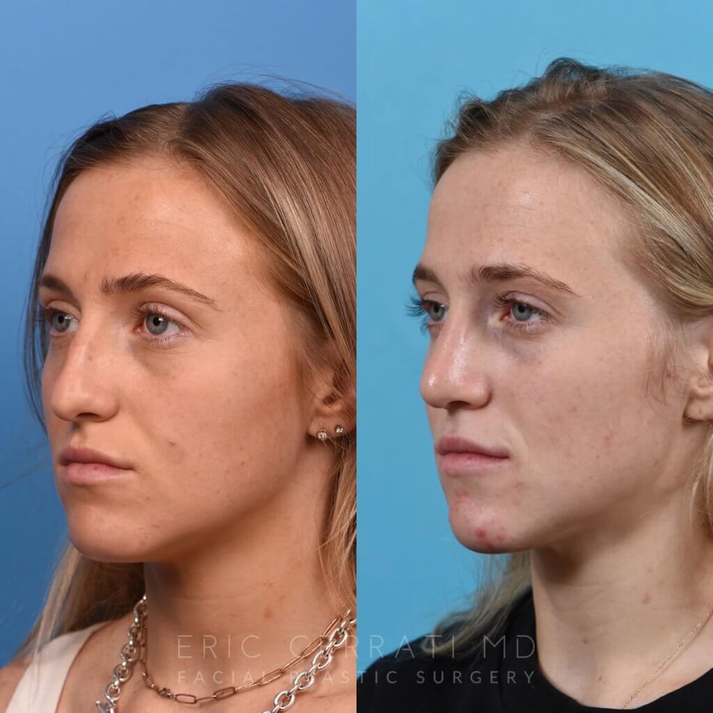 Female patient before and after rhinoplasty - left side