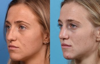 Female patient before and after rhinoplasty - left side
