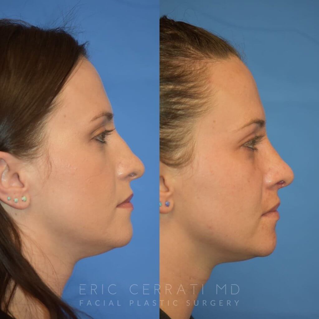 Female patient before and after rhinoplasty - right side