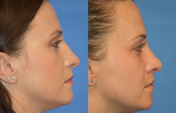 Female patient before and after rhinoplasty - right side
