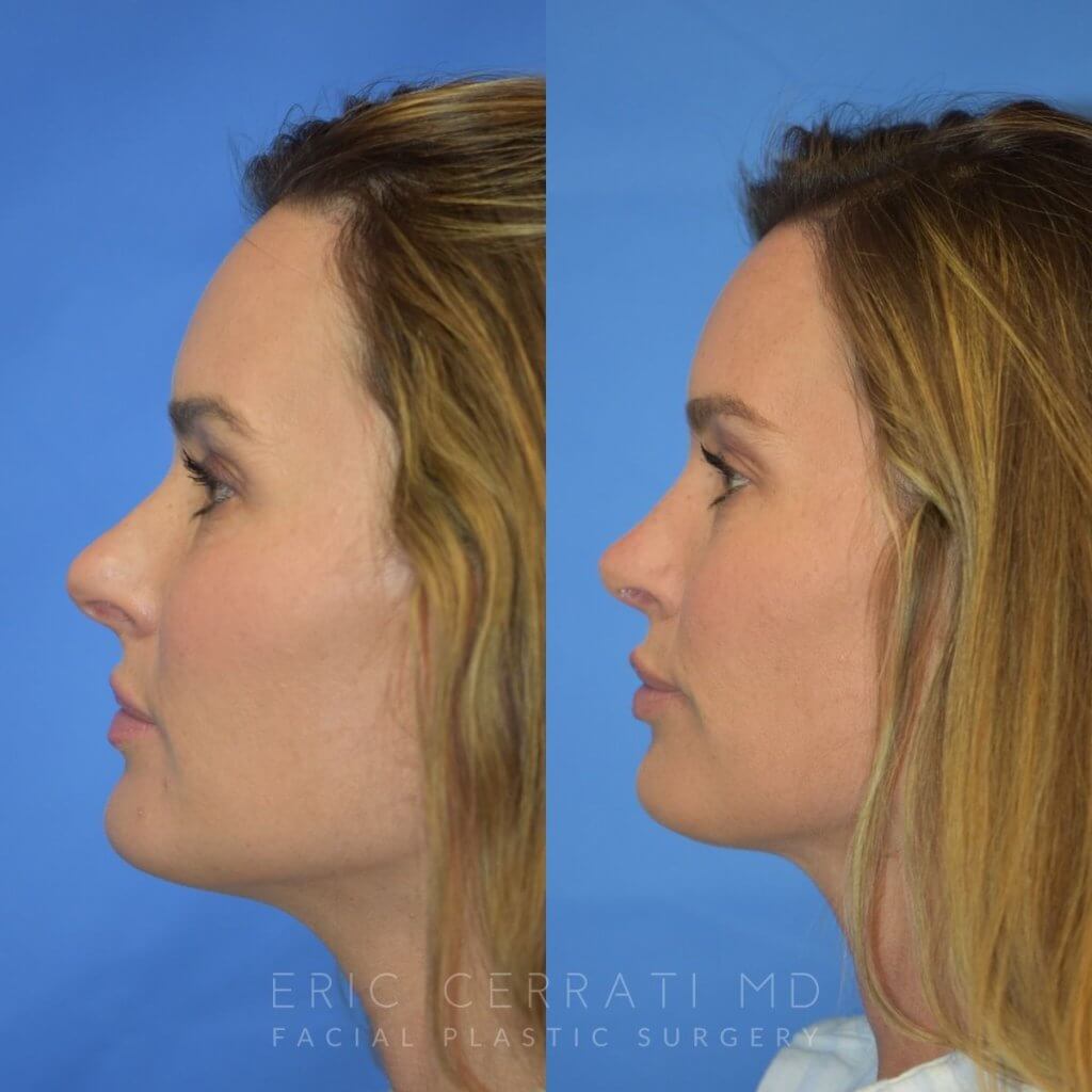 Female patient before and after rhinoplasty - left side