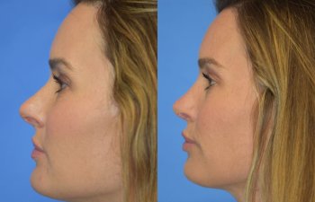 Female patient before and after rhinoplasty - left side