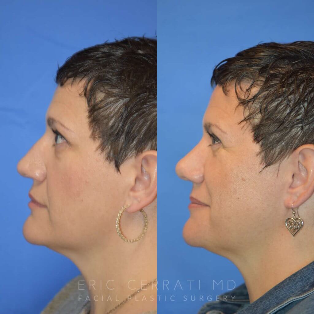 Female patient before and after rhinoplasty - left side