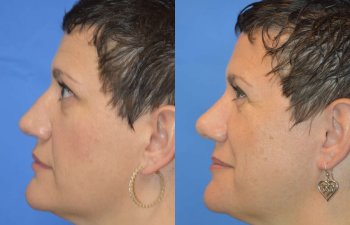 Female patient before and after rhinoplasty - left side