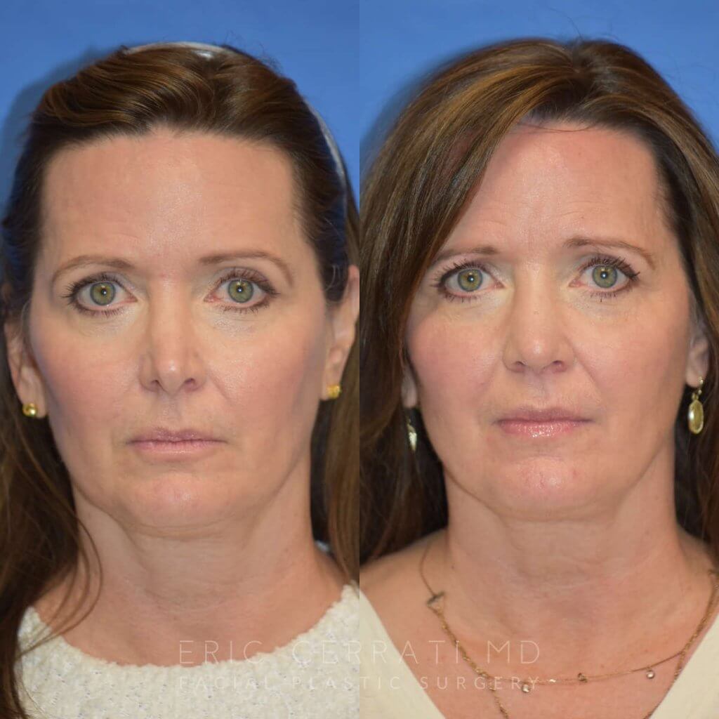 Female patient before and after rhinoplasty - front