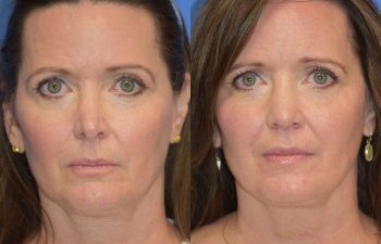 Female patient before and after rhinoplasty - front