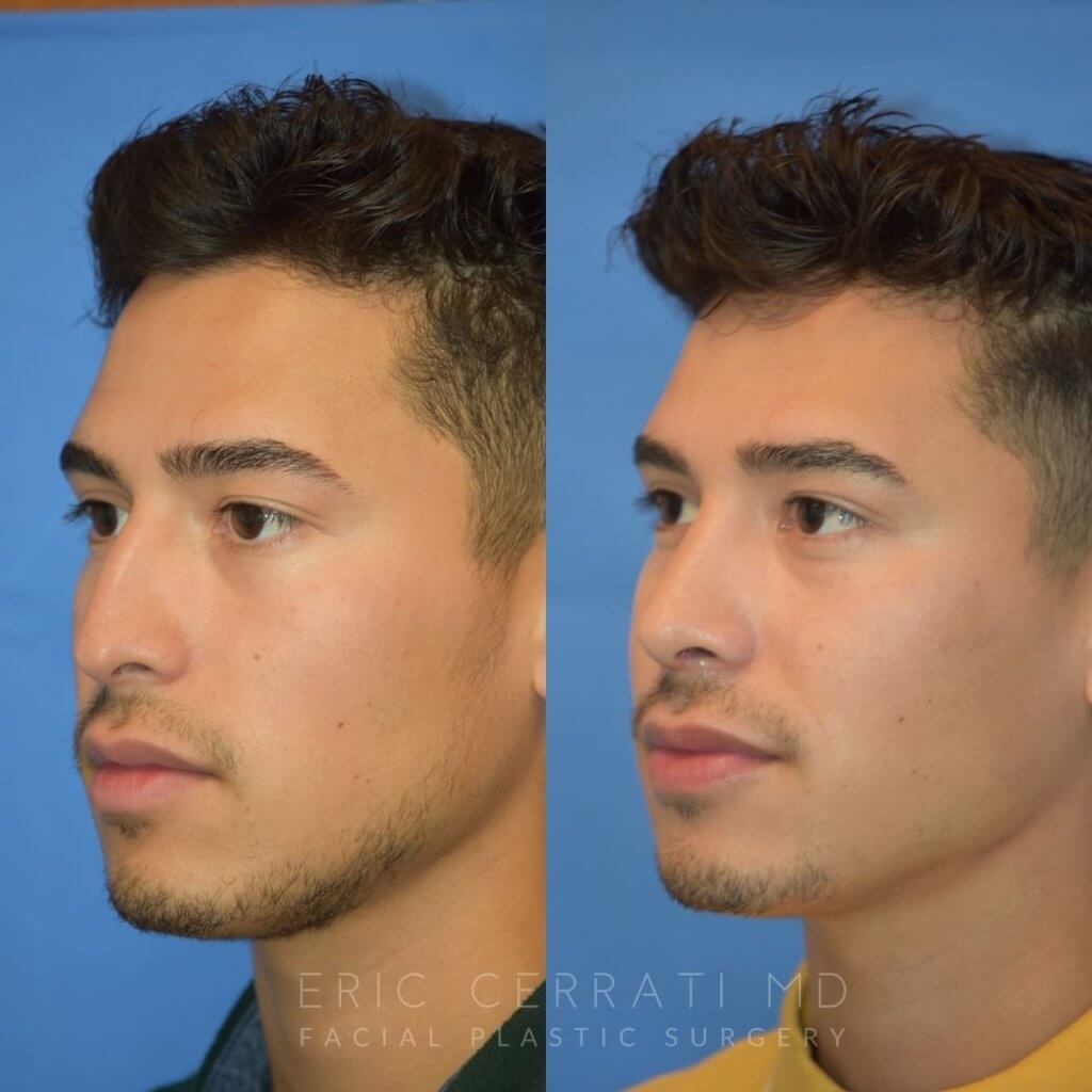 Male patient before and after rhinoplasty - front