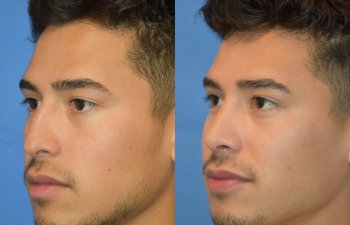 Male patient before and after rhinoplasty - front