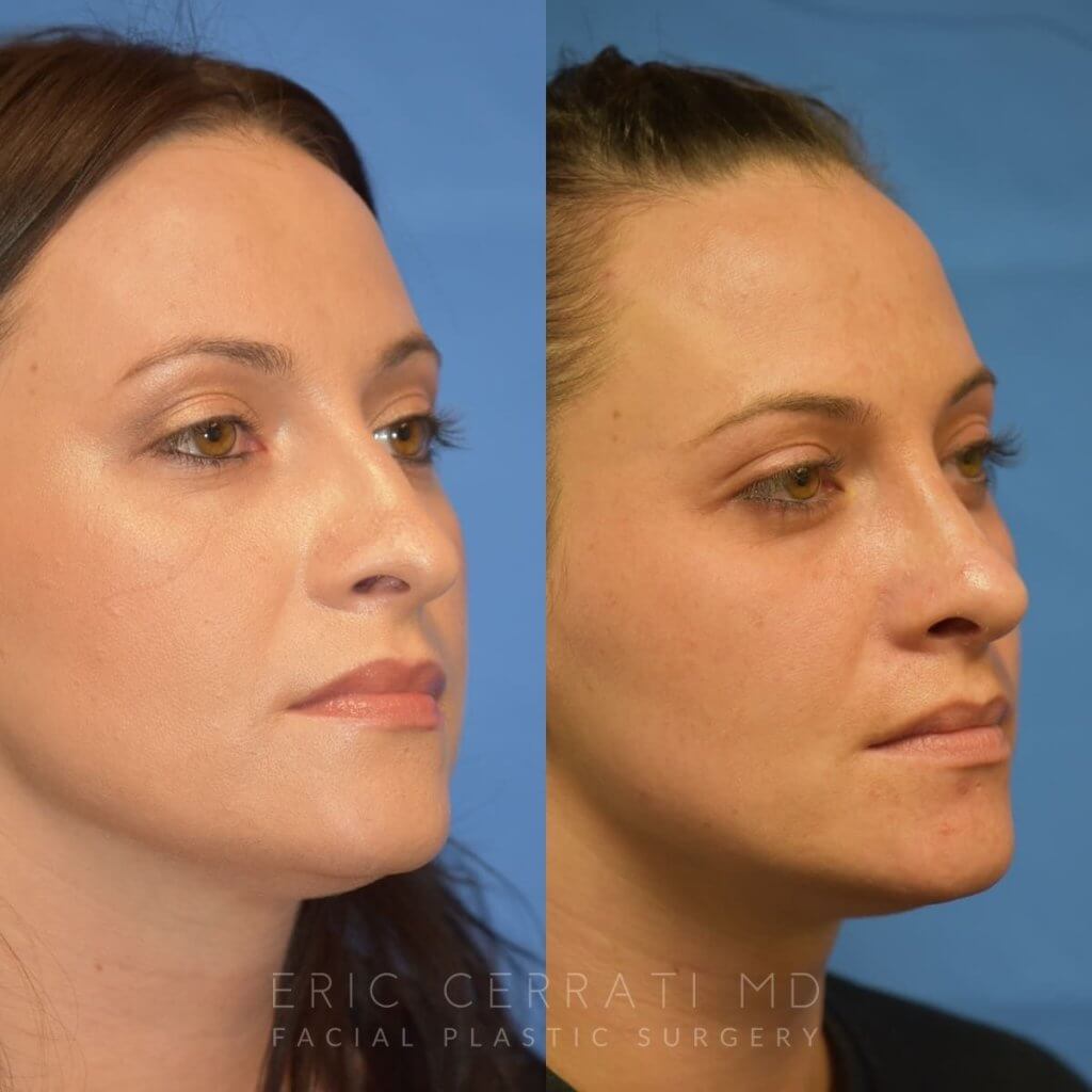 Female patient before and after rhinoplasty - right side