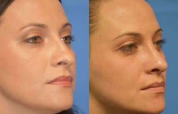 Female patient before and after rhinoplasty - right side