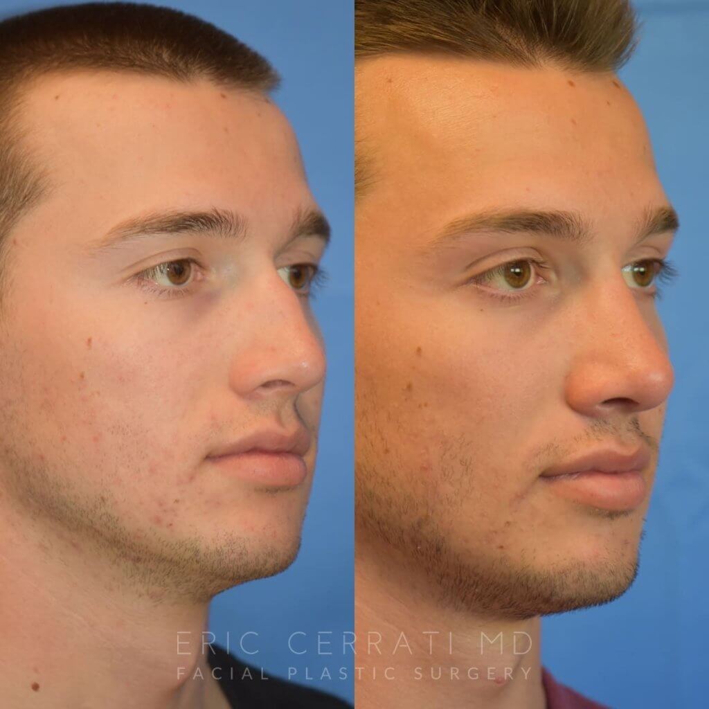 Male patient before and after rhinoplasty - right side