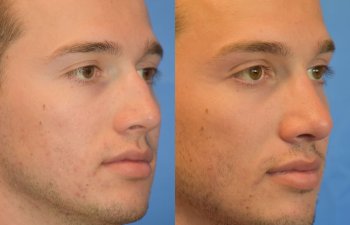 Male patient before and after rhinoplasty - right side