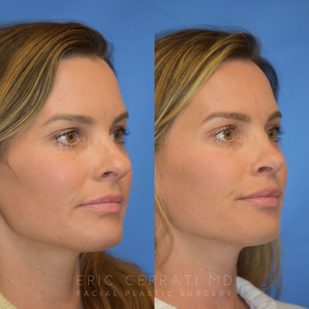 Female patient before and after rhinoplasty - right side