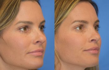 Female patient before and after rhinoplasty - right side