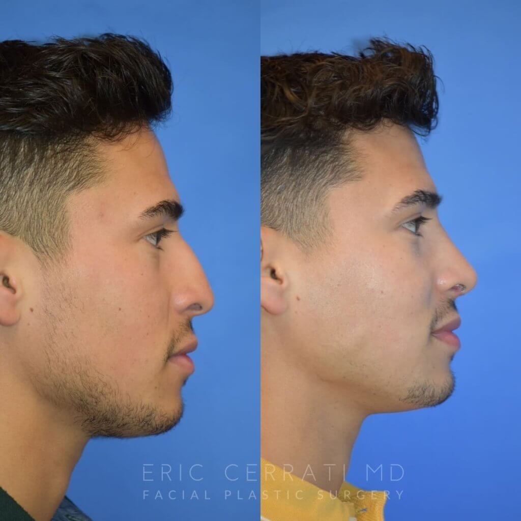 Male patient before and after rhinoplasty - front