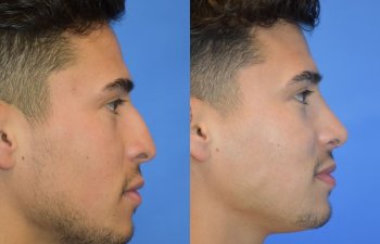 Male patient before and after rhinoplasty - front