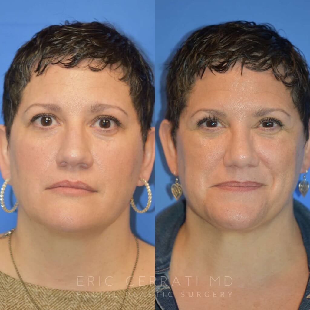 Female patient before and after rhinoplasty - front