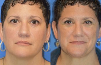 Female patient before and after rhinoplasty - front