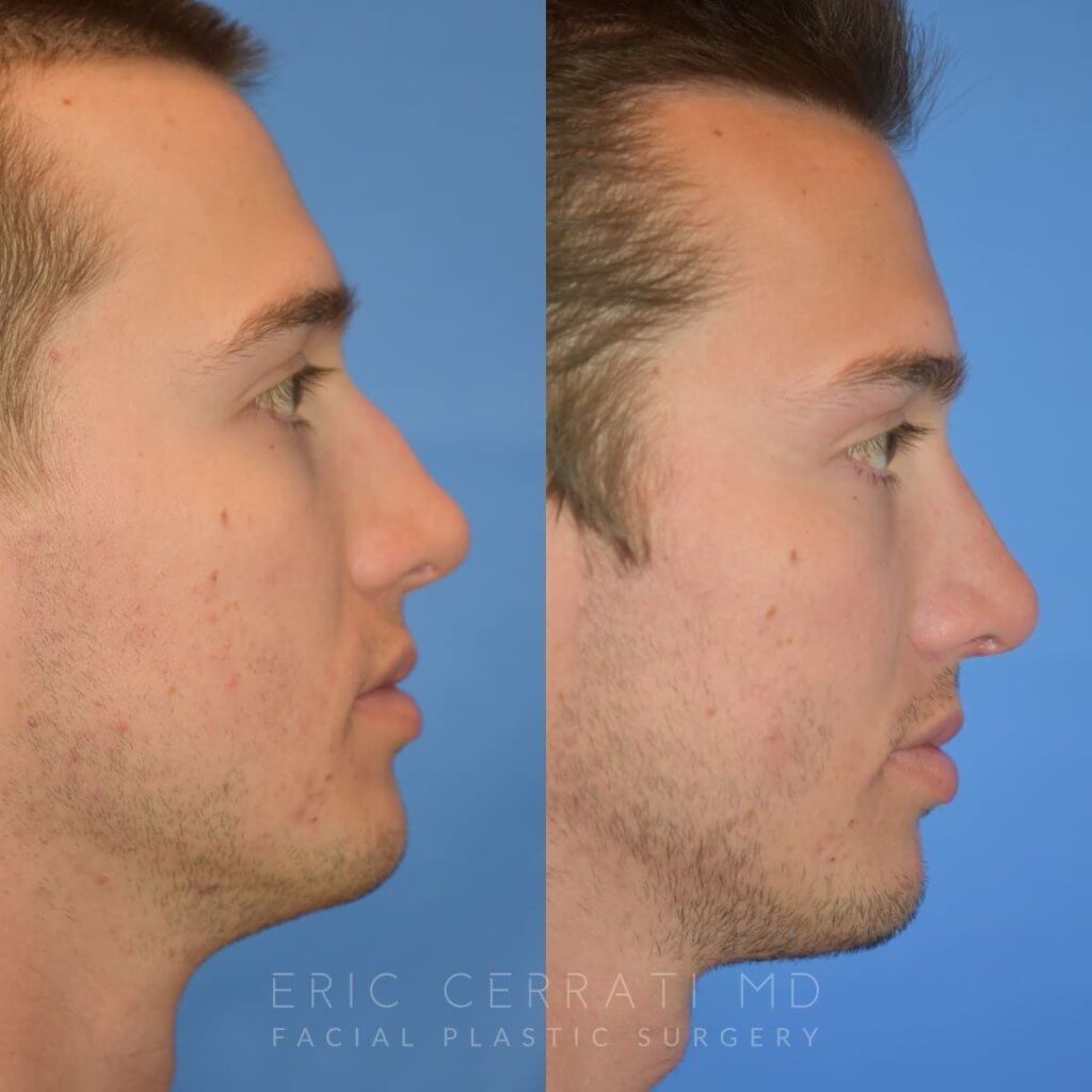 Male patient before and after rhinoplasty - right side